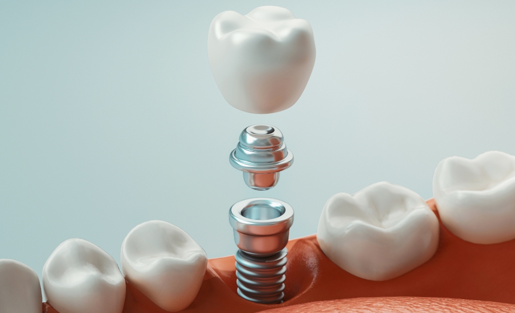 Animated dental implant being placed in the lower jaw