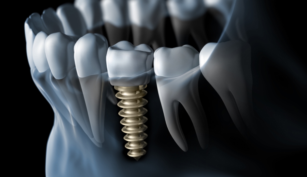 Animated x ray of a person with a dental implant