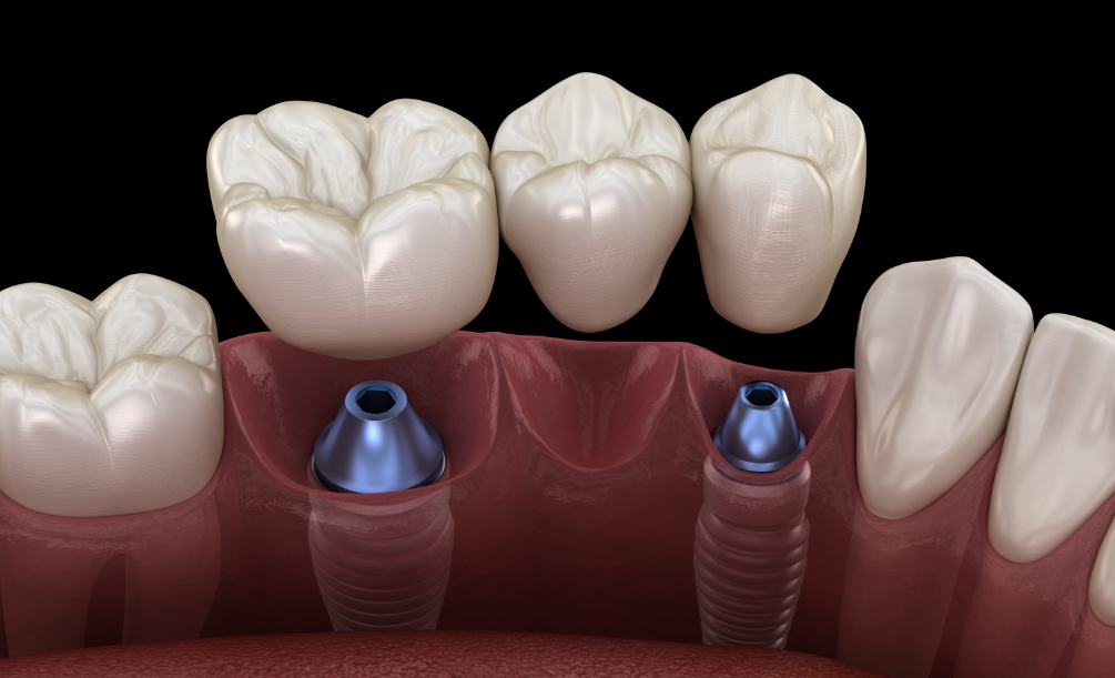 Animated dental bridge being placed over two dental implants in the lower jaw