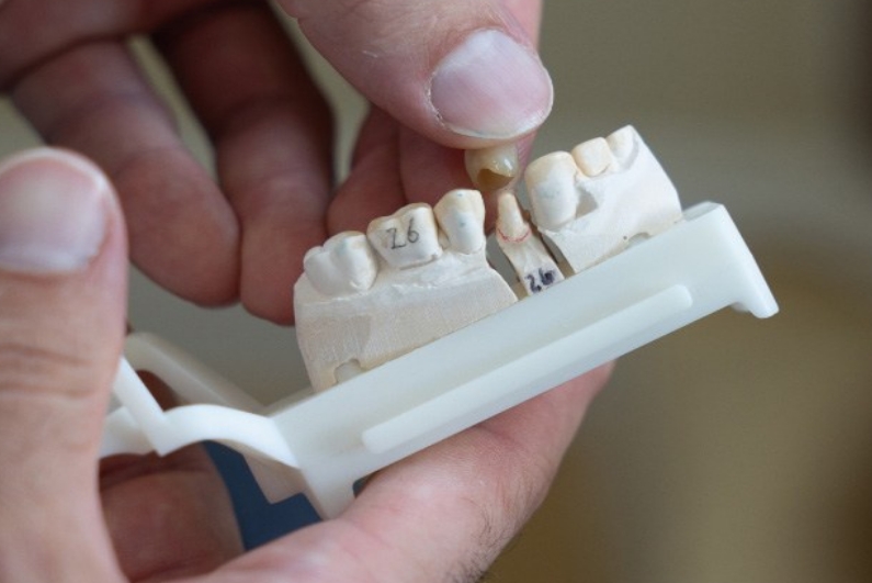 Close up of restorative dentist placing a dental crown on a model of the teeth
