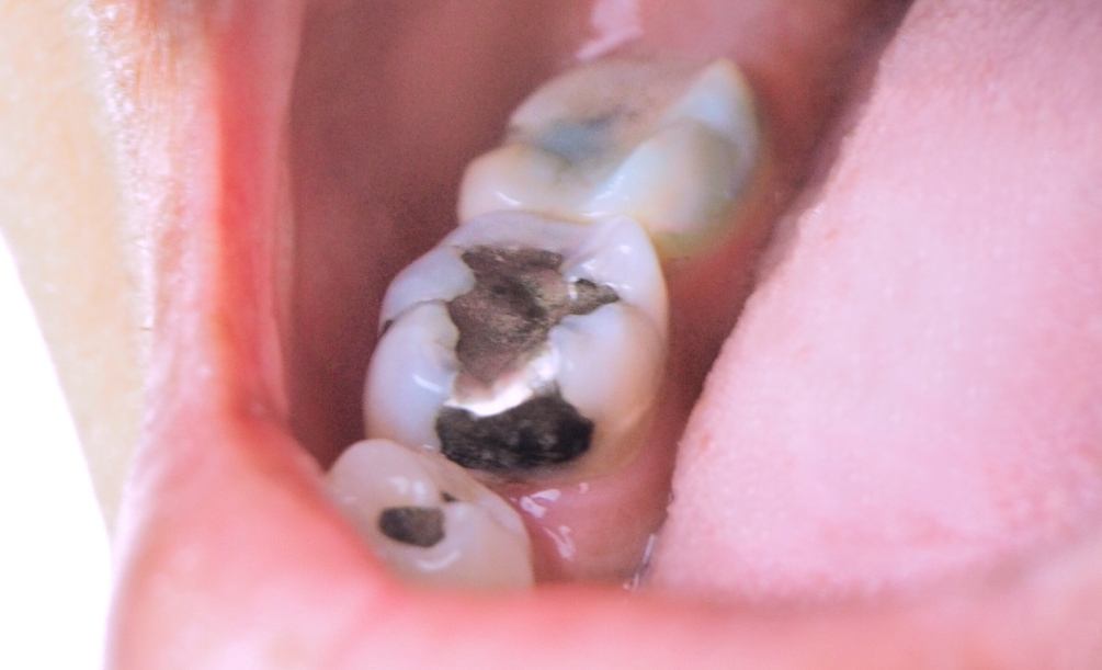 Close up of teeth with dark gray fillings