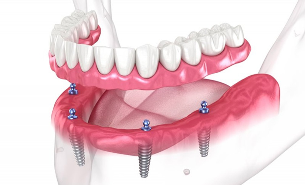 a 3 D illustration of all-on-6 dental implants