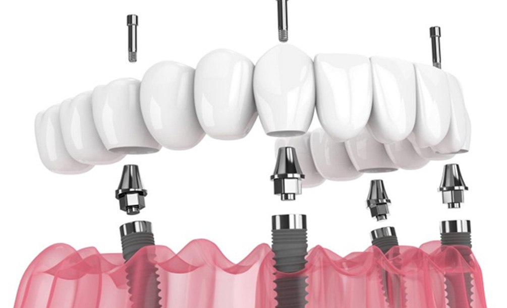 a 3 D illustration of all-on-4 dental implants