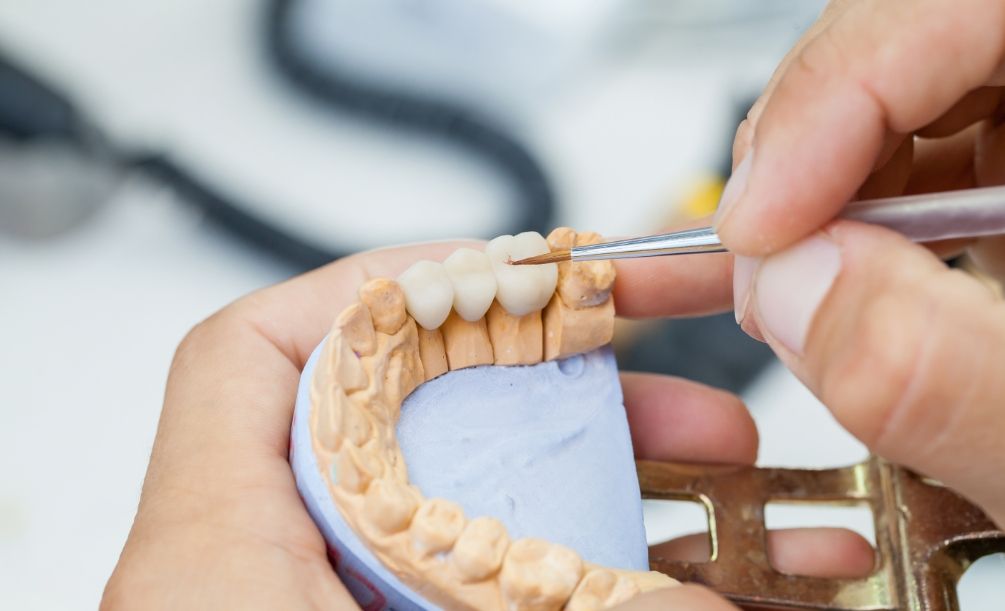 Dentist crafting a dental bridge