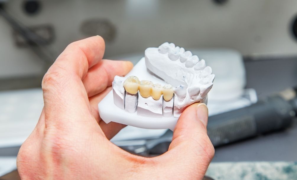 Person holding a model of the jaw with a dental bridge