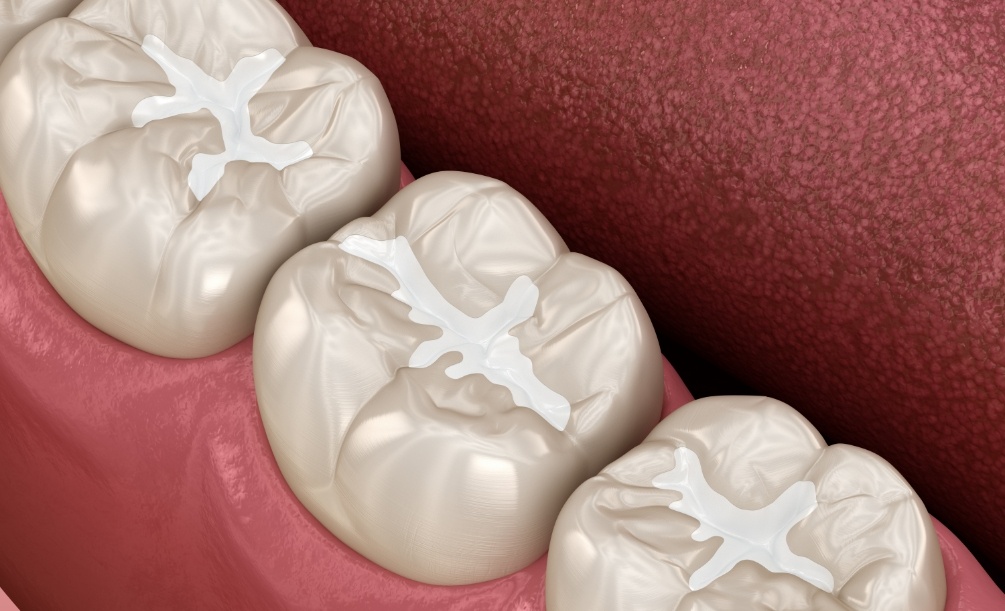 Close up of animated teeth with dental sealants