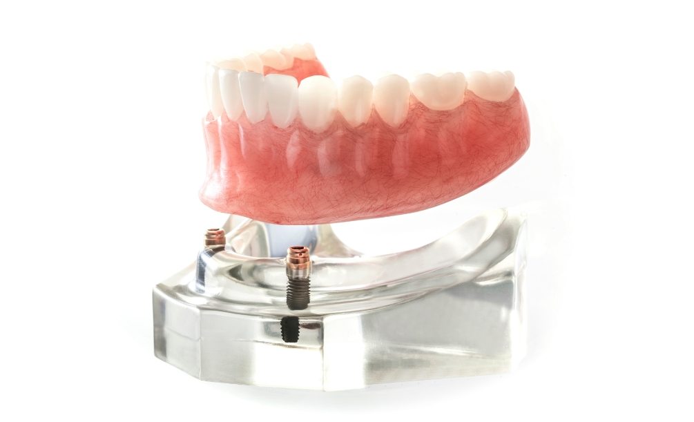 Denture being placed on a model of the jaw with dental implants