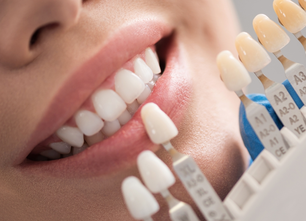 Close up of dentist holding shade guide in front of a smiling patient