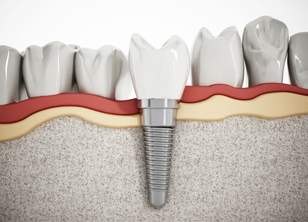 Animated dental implant with dental crown in the lower jaw