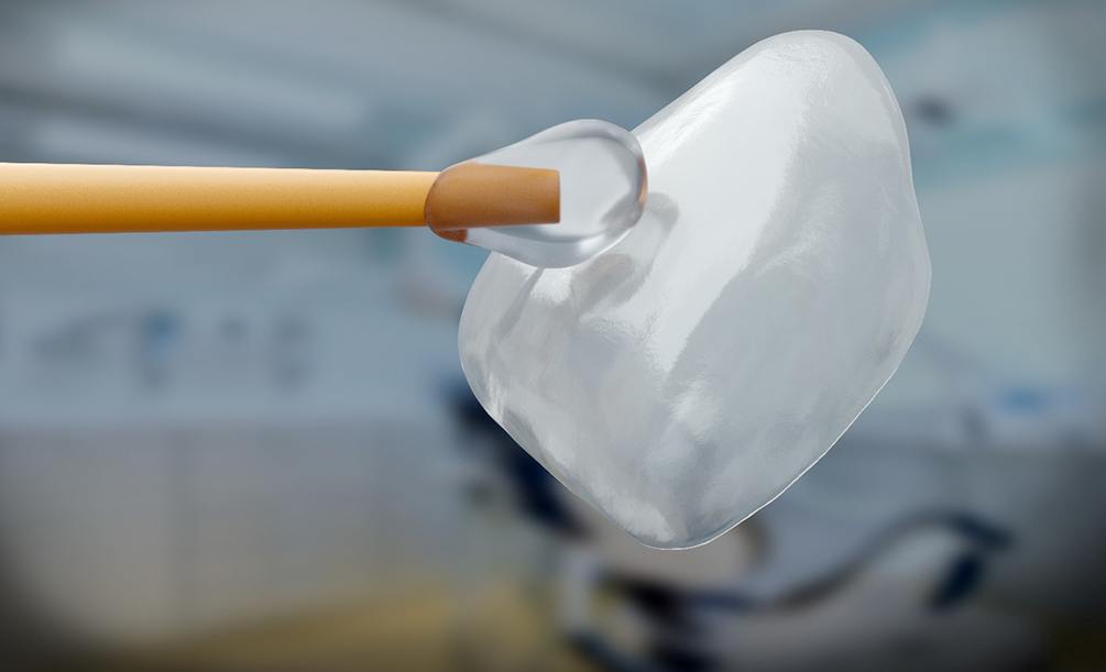 Closeup of a veneer held with dollop of clear cement