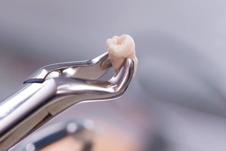 Dental forceps holding a tooth after wisdom tooth extractions in Ormond Beach