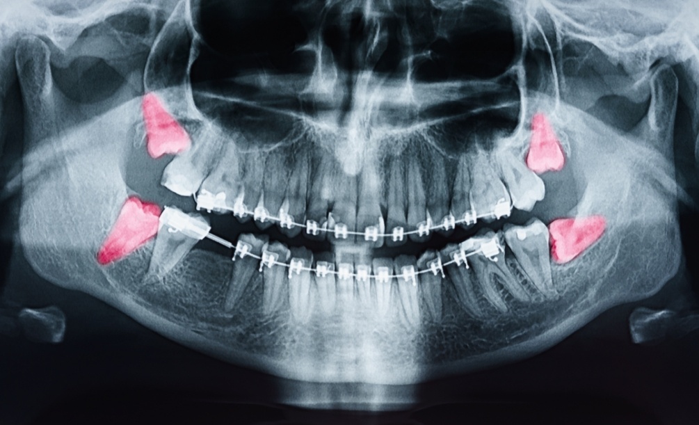 Dental X ray with the wisdom teeth highlighted red