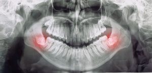 Grayscale x-ray image of a mouth full of teeth with the wisdom teeth colored red