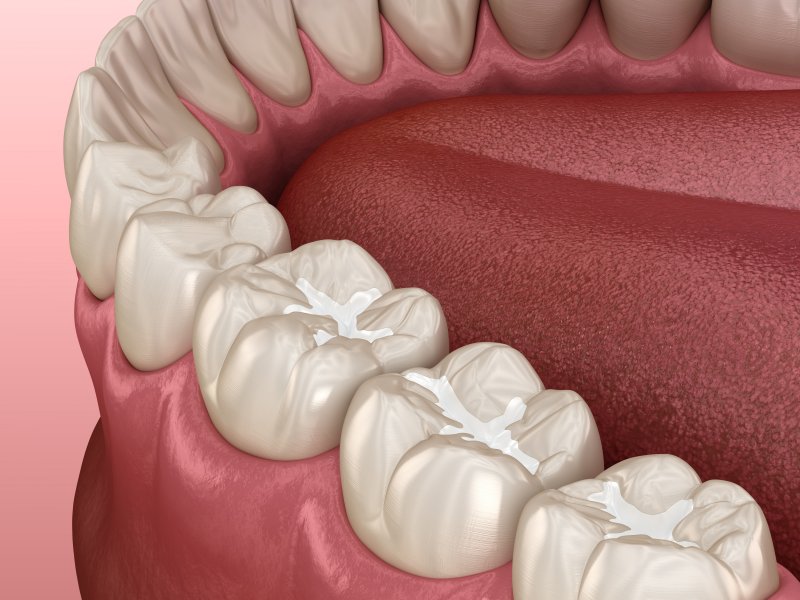 digital image of tooth-colored fillings