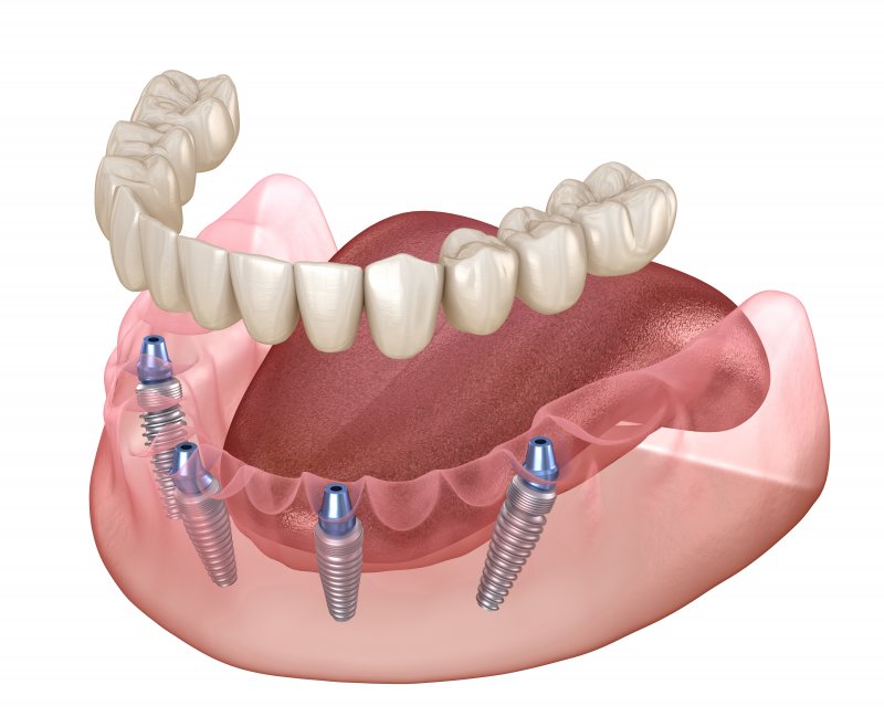 Exploded illustration of implant denture